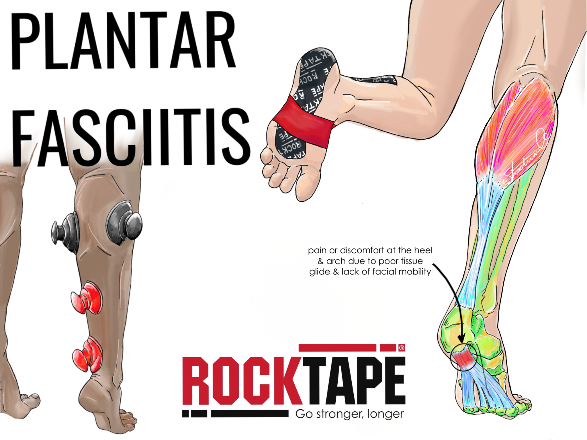 Treating Plantar Fasciitis with RockPods and RockTape